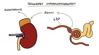 Hyperaldosteronism and Conns Syndrome [upl. by Anawqahs]