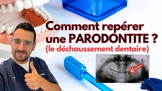 Apprendre à REPÉRER une PARODONTITE dentaire [upl. by Mandell]