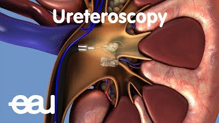 Removal of kidney stones URS [upl. by Lahcsap]