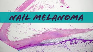 Subungual acral lentiginous melanoma in situ fingernail toenail nail melanoma pathology dermatology [upl. by Sterling]