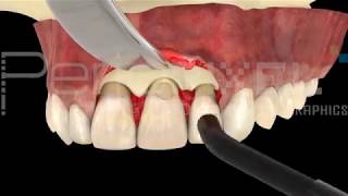 Caries Subgingival  PerioPixel [upl. by Beal]