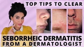 Top Tips to Clear Seborrheic Dermatitis  Dermatologist Deep Dive [upl. by Garnette]