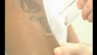 Laser Tattoo Removal on Dark Skin with the MedLite [upl. by Danielle967]