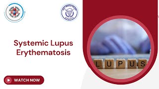 Systemic Lupus Erythematosis [upl. by Eustace]