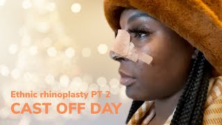 Ethnic rhinoplasty in turkey dr Umit taskin part 2 cast removal [upl. by Atikcir467]