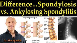 The Difference Between Spondylosis amp Ankylosing Spondylitis  Dr Alan Mandell DC [upl. by Babcock]