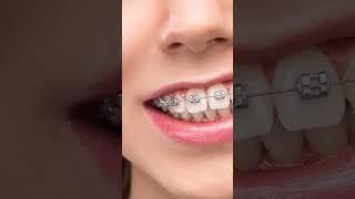 ¡Logra la sonrisa perfecta con nuestros brackets por solo RD11000 Dental Rostro [upl. by Aninaj]