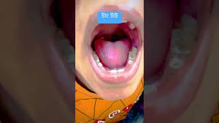 টাং টাই। Tongue tie viralshort doctor নাককানগলা [upl. by Sile]