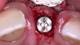 How to extract a tooth with severe resorption [upl. by Jobe]