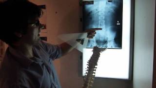 Chiropractor Arthritis disc back Perth clinic XRay radiograph low backMTS [upl. by Anuahs]