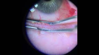 Meibomian Gland Expression Upper and Lower Lid [upl. by Lynette892]