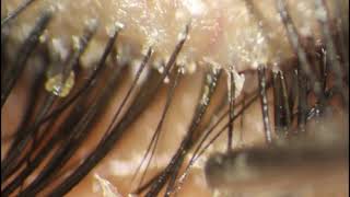 Demodex Mite Picked Up and Put Down at 330 [upl. by Lubow]