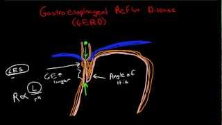 Pathophysiology of Gastroesophageal Reflux Disease GERD [upl. by Steck]