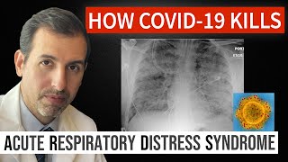 How Coronavirus Kills Acute Respiratory Distress Syndrome ARDS amp COVID 19 Treatment [upl. by Nafis]