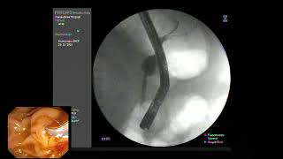 ERCP  Papillitis from recently passing CBD stone [upl. by Lirret343]