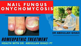 Onychomycosis  Nail Fungus Homeopathic Treatment  Dr Abdullah Ghazi [upl. by Aneehsak798]