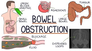 Understanding Bowel Obstruction [upl. by Razaele]