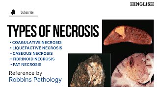 Necrosis  Types of Necrosis  Coagulative  Liquefactive  caseous  Fat  Fibrinoid  KTC MBBS [upl. by Omsoc100]