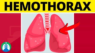 Hemothorax Medical Definition  Quick Explainer Video [upl. by Pogah]