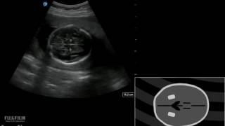 How To Pregnancy BPD HC AC and FL Measurements 3D Video [upl. by Brenner]