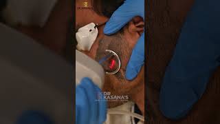 co2 Laser Treatment for Birthmark Removal [upl. by Locklin]