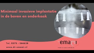 Implantaat implantatie zonder operatie flapless gehemelte vrije prothese [upl. by Nesline521]