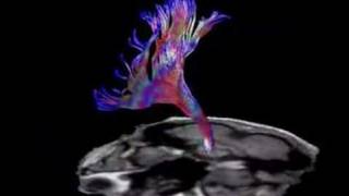 Brain Fiber Tractography [upl. by Onaireves]