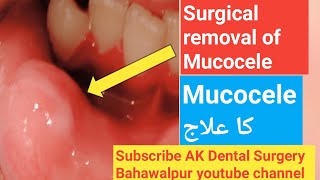 oral pathology  Surgical removal of Mucocele  Mucocele ka ilaj  oralpathology [upl. by Garlen]