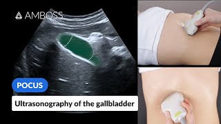 Point of Care Ultrasound of the Gallbladder  AMBOSS Video [upl. by Xanthus]