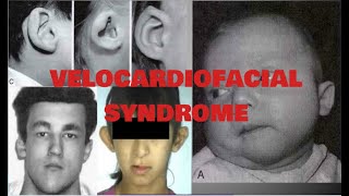 WHAT IS VELOCARDIOFACIAL SYNDROME VCFS Symptoms of Velocardiofacial syndrome  VCFS FISH [upl. by Yesnnyl]