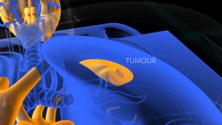 PET Scan animation [upl. by Rainwater]