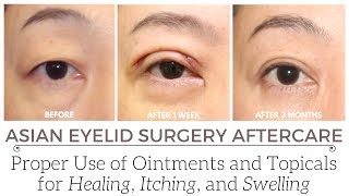 Why Antibiotic Ointments Should be Limited to the First Few Days After Eyelid Surgery [upl. by Samuel]