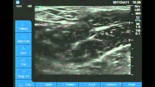 Ultrasound Guided obturator nerve block [upl. by Mayram]