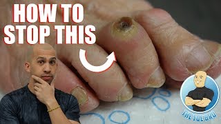 FOOT CORN REMOVAL FULL TREATMENT  FOOT HEALTH MONTH 2018 3 [upl. by Bellamy]