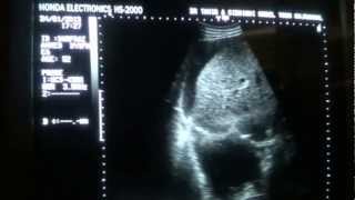 ASCITIC vs PLEURAL FLUID differentiation by ultrasound [upl. by Agneta353]