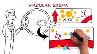 Retinal Vein Occlusion [upl. by Eremaj468]