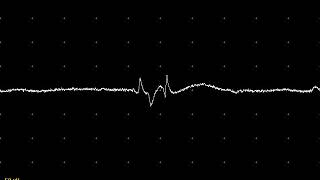 EMG teaching video 5 Abnormal spontaneous activity PSW Fibs and fasciculations [upl. by Forrest]