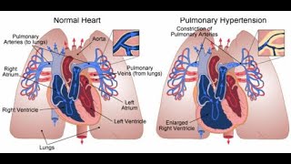 DU CPC Université de Paris Hypertensions pulmonaires de lenfant et des cardiopathies congénital [upl. by Teodoro]