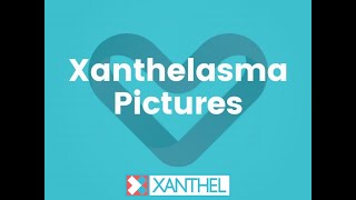 Xanthelasma Pictures  Trying to find pictures of Xanthelasma And Xanthomas  By XANTHEL ® [upl. by Alled]