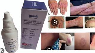 Halovik Lotion Halobetasol Propionate Lotion [upl. by Batish395]