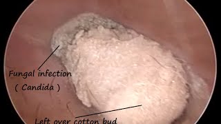 Removal of left over cotton bud  Q Tip   It causes Fungal infection with minute perforations [upl. by Spike]