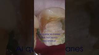 Incrustación OnLay de Zirconia caries salud dientes odontologia estetica [upl. by Cnahc]