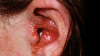 Acute Ear Inflammation  Otitis Externa  What is the Symptoms and treatment [upl. by Whiffen]