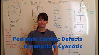 Pediatric cardiac defects  Acyanotic amp Cyanotic [upl. by Cartan649]