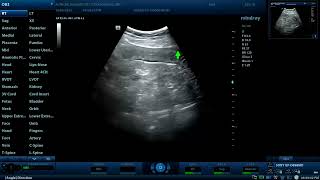 Enterocolitis Diagnostic ultrasound cases [upl. by Ffoeg]