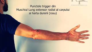 Cotul tenismenului Epicondilita laterala Preventie  Tratament  SelfTreatment of pain [upl. by Mayfield270]