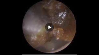 756  Shut Ear Canal Ear Wax Removal [upl. by Tennes]