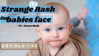 RashTeething Rash  Red Patch or dots on face of baby around 6months of age [upl. by Rosdniw989]