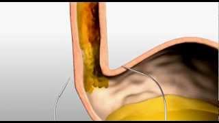 Endostim  slokdarm kringspier stimulator  pacemaker tegen zuurbranden refluxziekte [upl. by Niatirb]