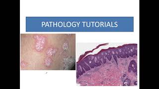 Psoriasis histopathological features psoriasiform dermatitis [upl. by Beatriz]